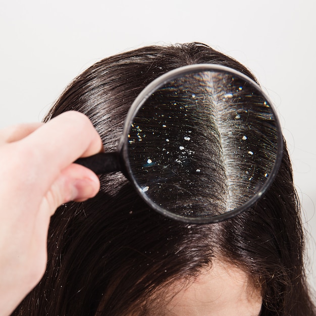 doctor-looks-through-magnifying-glass-dandruff-dark-female-hair_213607-54